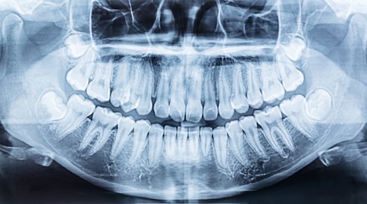 after extraction wisdom tooth extraction wodonga