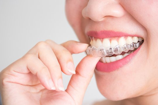 invisalign wodonga