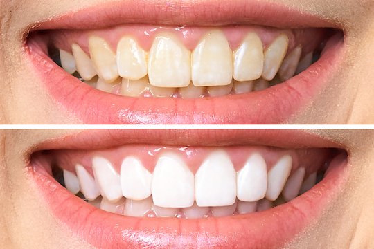 teeth whitening wodonga