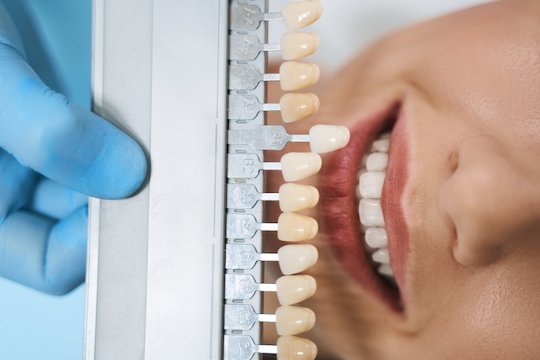 types of dental veneers available wodonga