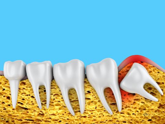 wisdom tooth extraction wodonga