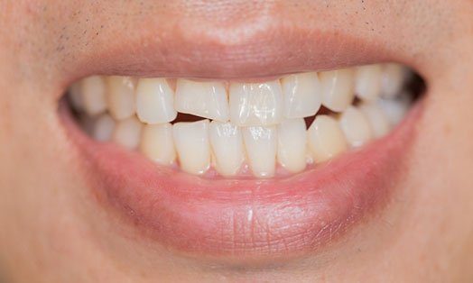 broken tooth management wodonga