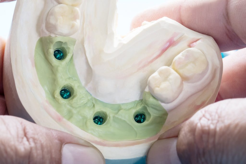dental implants in wodonga should you shop around