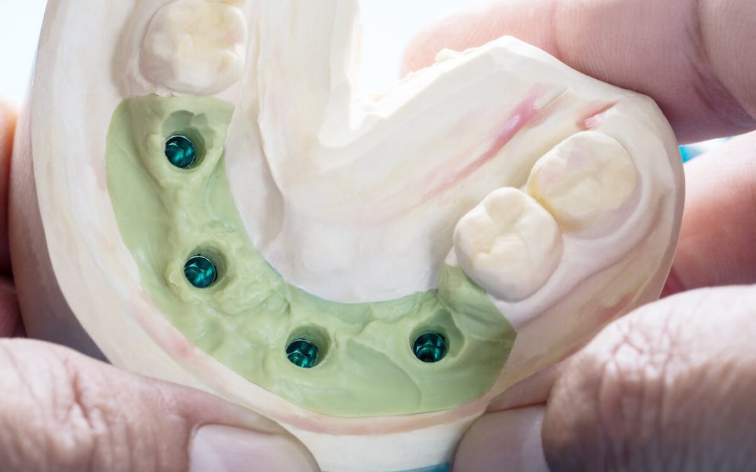 Dental Implants in Wodonga: Should You Shop Around?