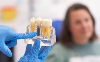 How Long Do Dental Implants Last?