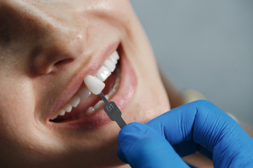 are dental veneers permanent