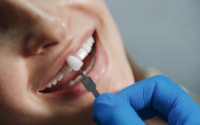 Are Dental Veneers Permanent? What You Need to Know