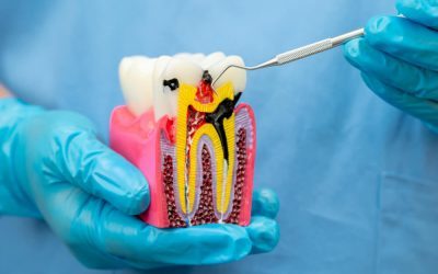 Root Canal Treatment for Infected Teeth – Saving Natural Teeth Effectively