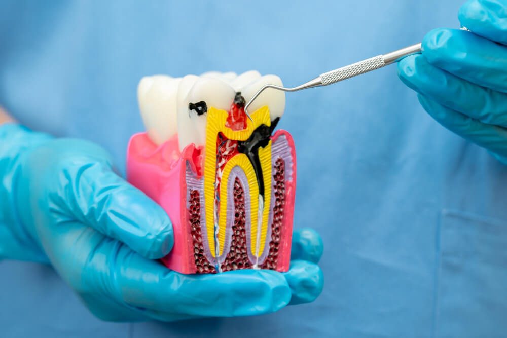Root Canal Treatment for Infected Teeth – Saving Natural Teeth Effectively