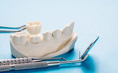 How Long Do Dental Crowns Last and What Affects Their Lifespan?