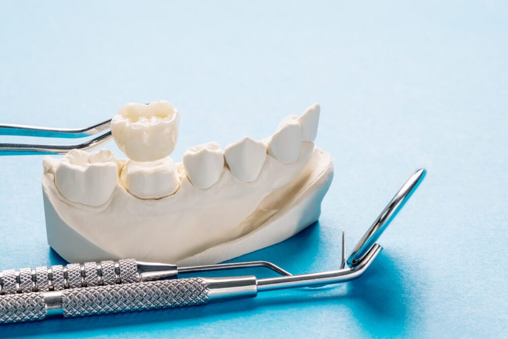 How Long Do Dental Crowns Last and What Affects Their Lifespan