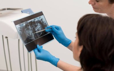 Tooth Extraction: What to Expect Before, During and After